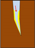 Fractures image three